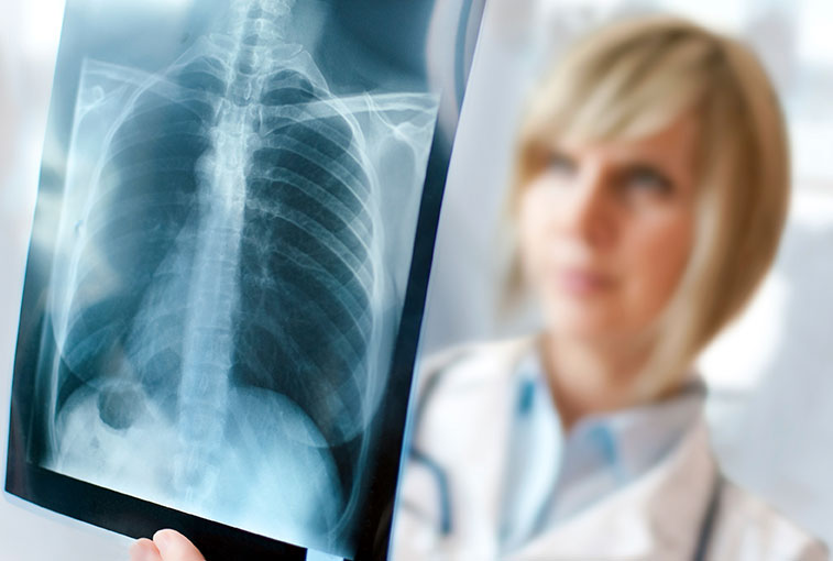 lung cancer x-ray