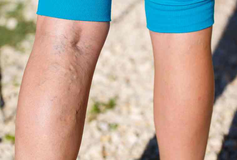 vericose veins on legs can indicate a vascular disease