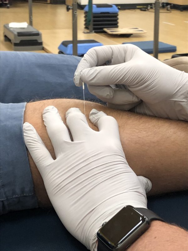 Two hands in surgical gloves insert a needle into a patient's leg during a dry needling session.