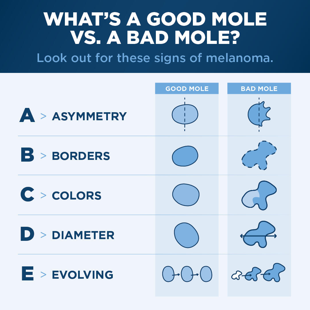 Sanford Health graphic titled "What's a good mole vs. a bad mole? Look out for these signs of melanoma. A - asymmetry. B - borders. C - colors. D - diameter. E - evolving." Illustrations show examples next to each letter.