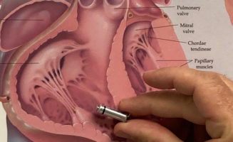 Bismarck patient receives smallest pacemaker in the world
