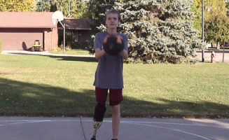 Prosthetic helps young patient after leg amputation
