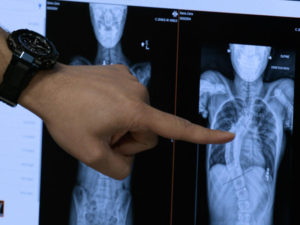 Closeup of a Sanford Health doctor's hand pointing to an X-ray of a scoliosis patient's curved backbones.