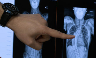 Surgery helps repair middle schooler’s severe scoliosis