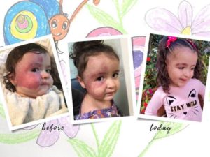 Three photos of a baby girl growing up with smaller and smaller port wine stain birthmarks on her face.