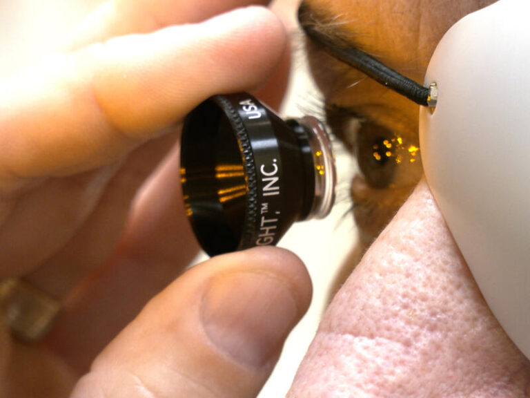 New lens allows for vision correction after cataract surgery Sanford