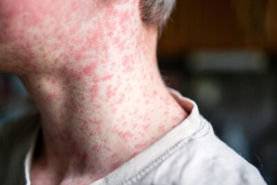 A teenager's face and neck covered in measles rash.