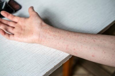 A teenager's hand and arm covered in measles rash.