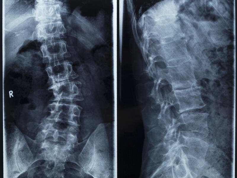 Pediatric scoliosis: What every parent should know