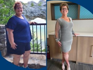 Weight loss surgery patient Sue Novak before and after