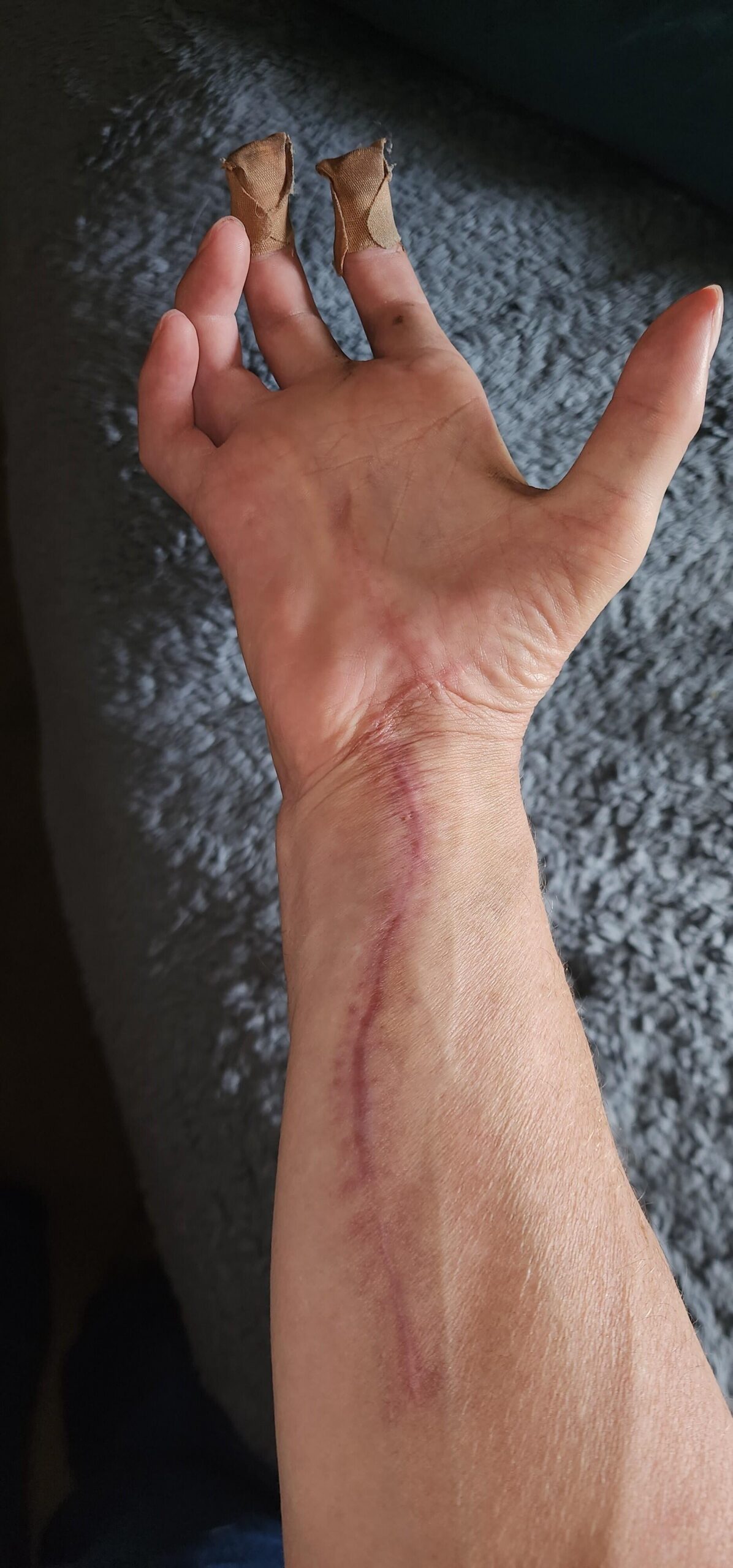 Patient's arm with scar from hand surgery.