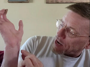 Hand surgery patient points to scars
