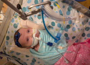 Calm baby with hair bow and breathing tubes in a hospital bed.